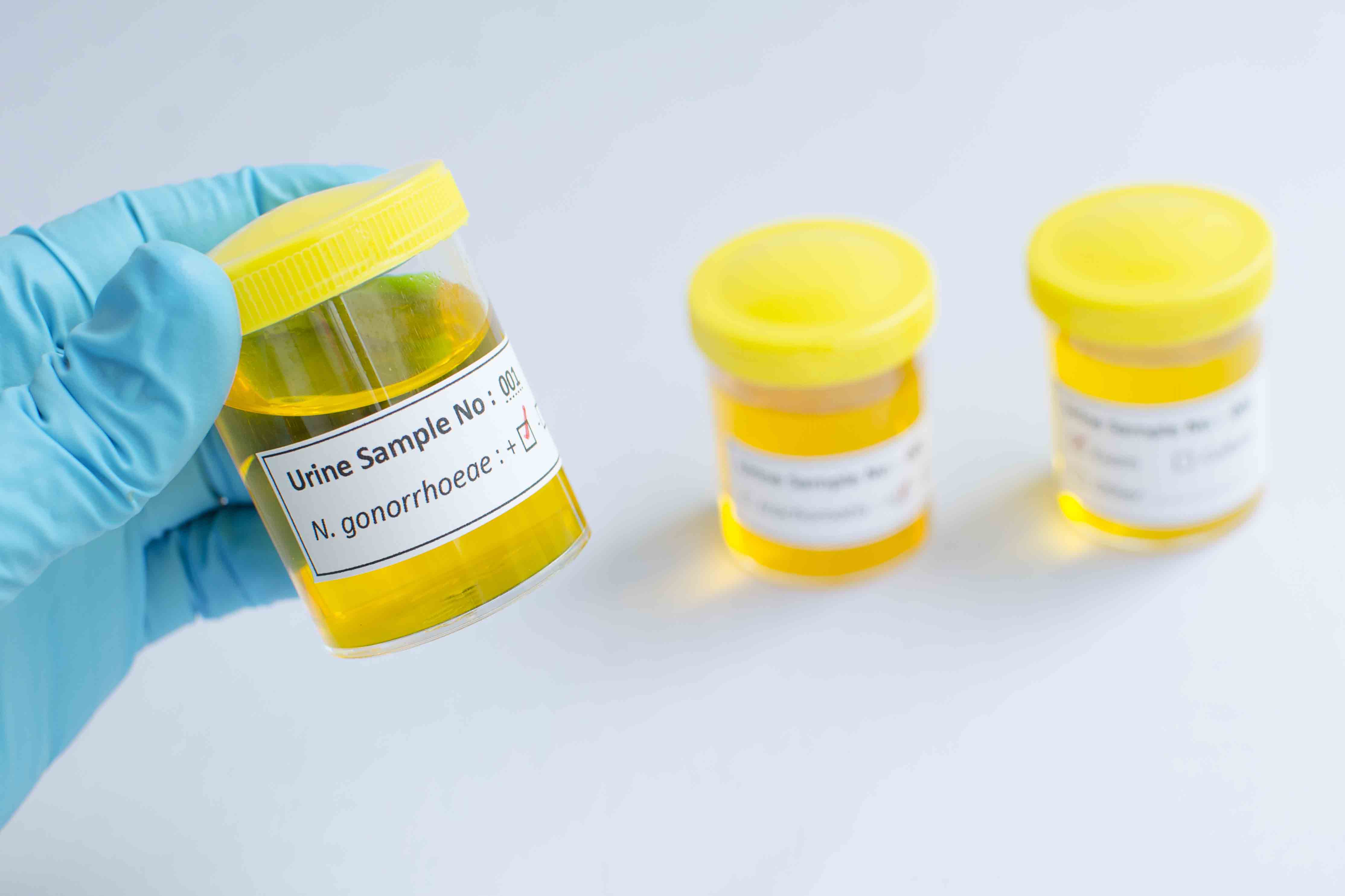 Gonorrhoea